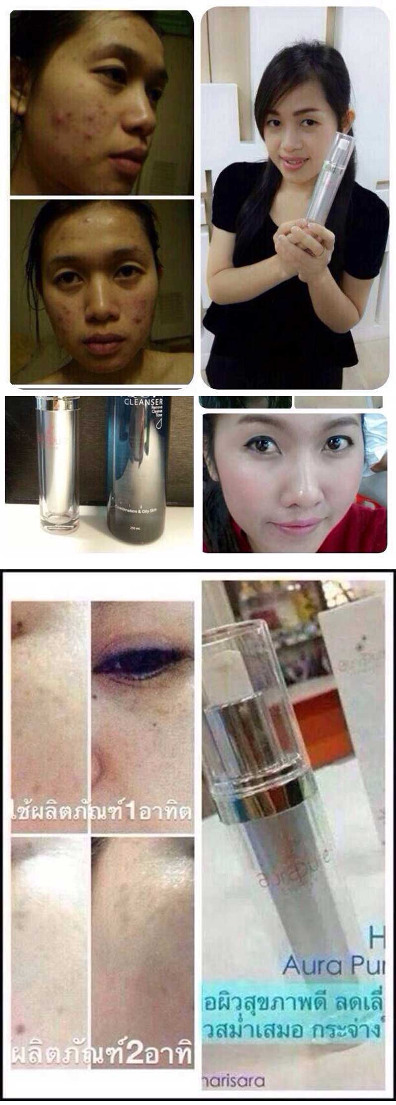 HyBeauty Aura Pure Essence (Aura pure serum) ขนาด 10 ML.  ลดสิว เพื่อผิวขาว สว่าง กระจ่างใสดุลออร่า